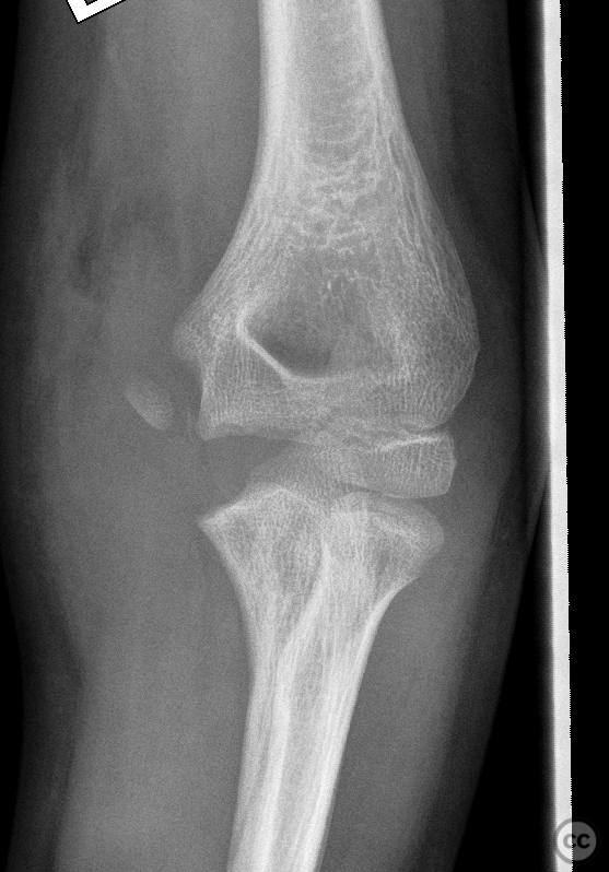 Pediatric Elbow Dislocation With Medial Epicondyle Fracture 3873